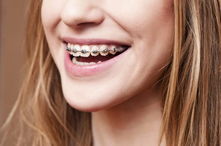 The Process and Varieties of Dental Braces: A Deciphering Guide