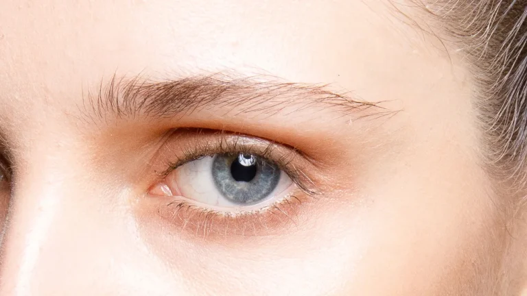 persistent eye bags